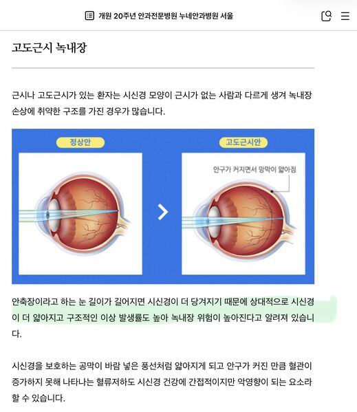파일:고도근시녹내장.jpeg