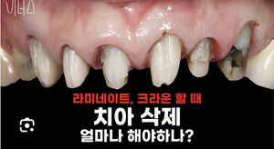 라미네이트실체.jpeg